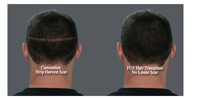 FUE _LinearScar_Comp_Gray Back